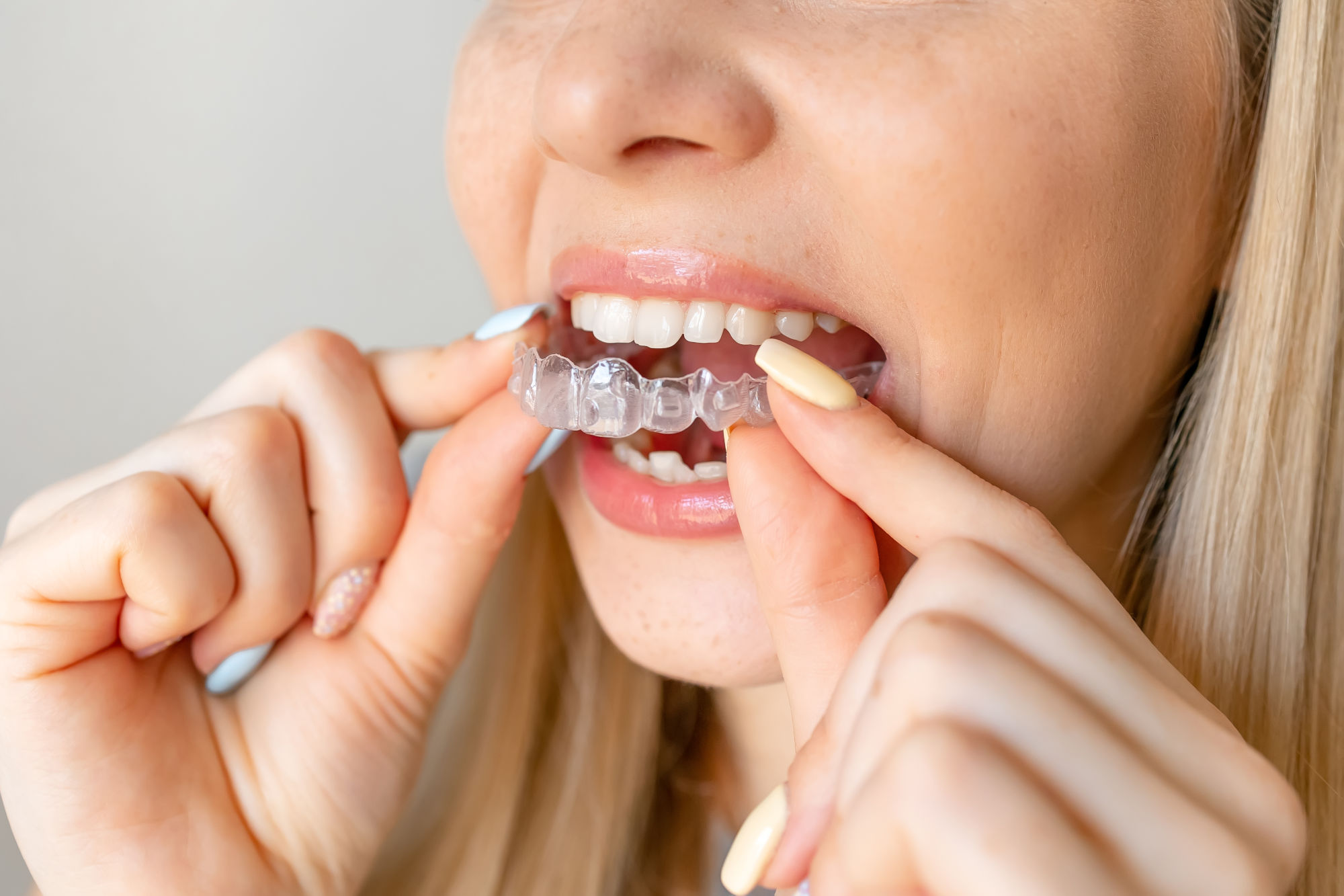 The Price of Clear Aligners: A 2025 Cost and Value Breakdown