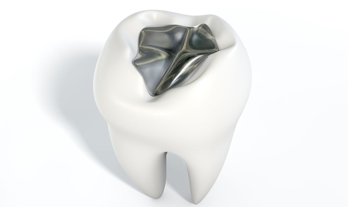Dental Amalgam Filling: All About This Controversial Filling