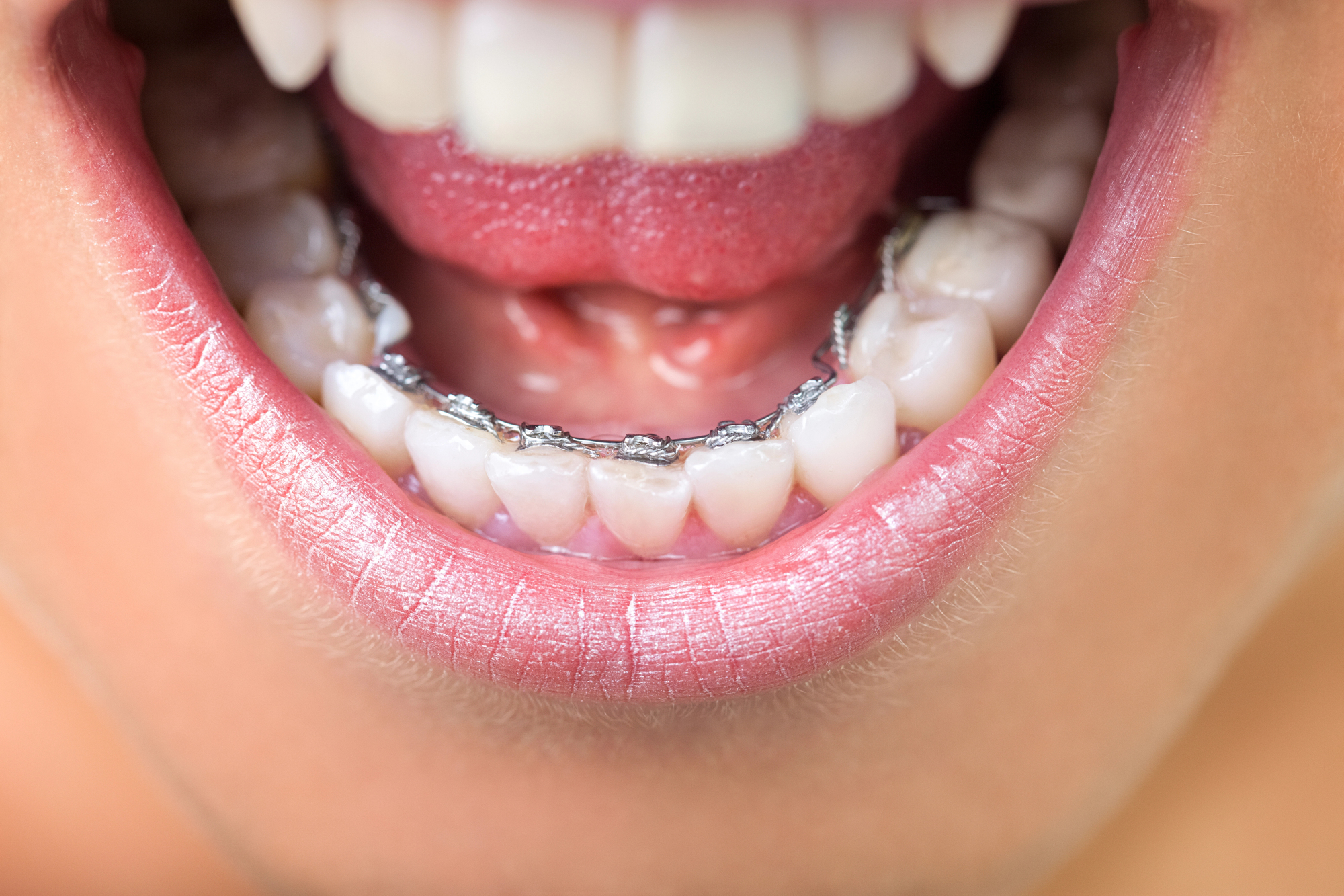 Lingual Braces: The Truly Invisible Path to a Perfect Smile