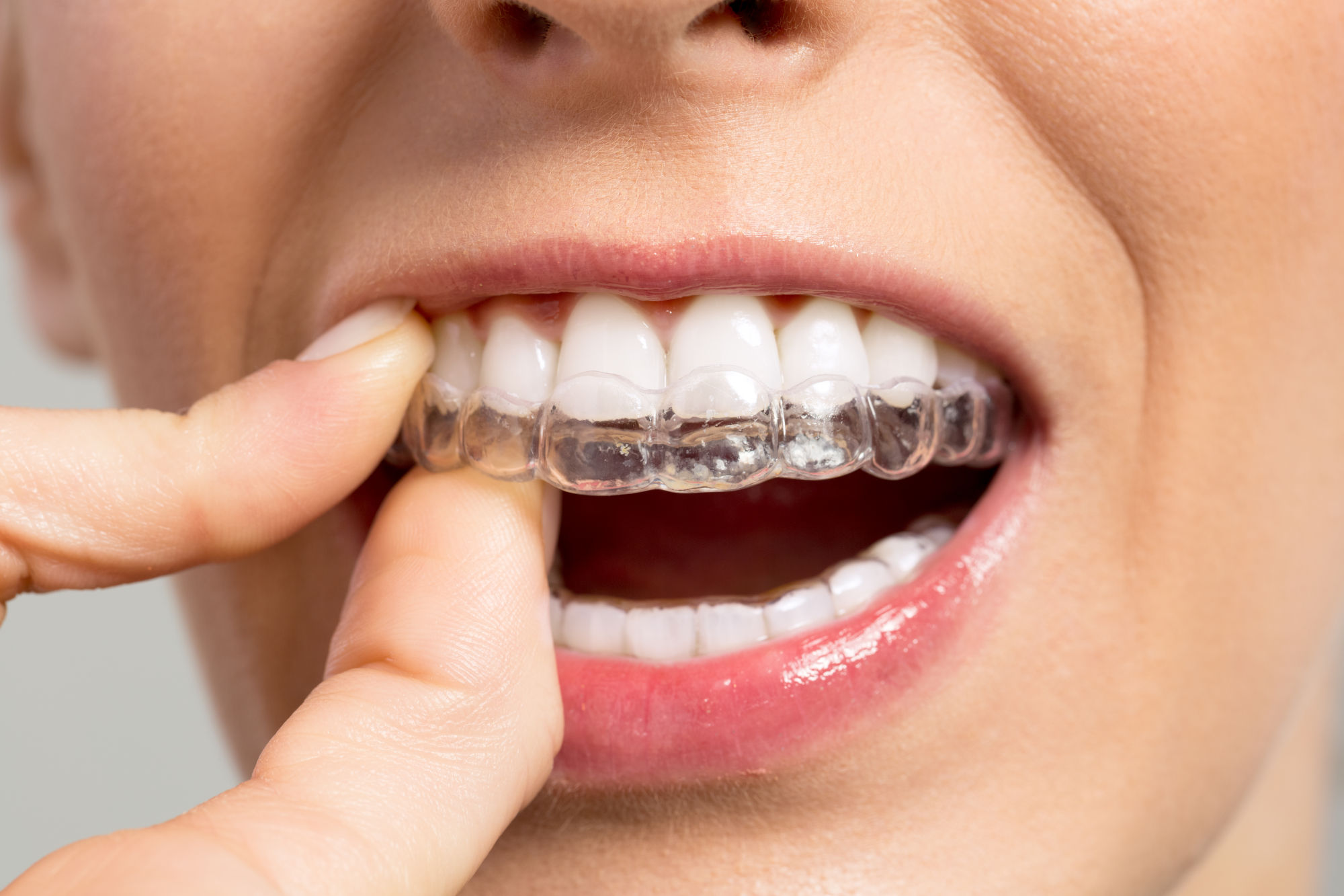 Invisible Braces: A 2025 Guide to Discreet Smile Correction