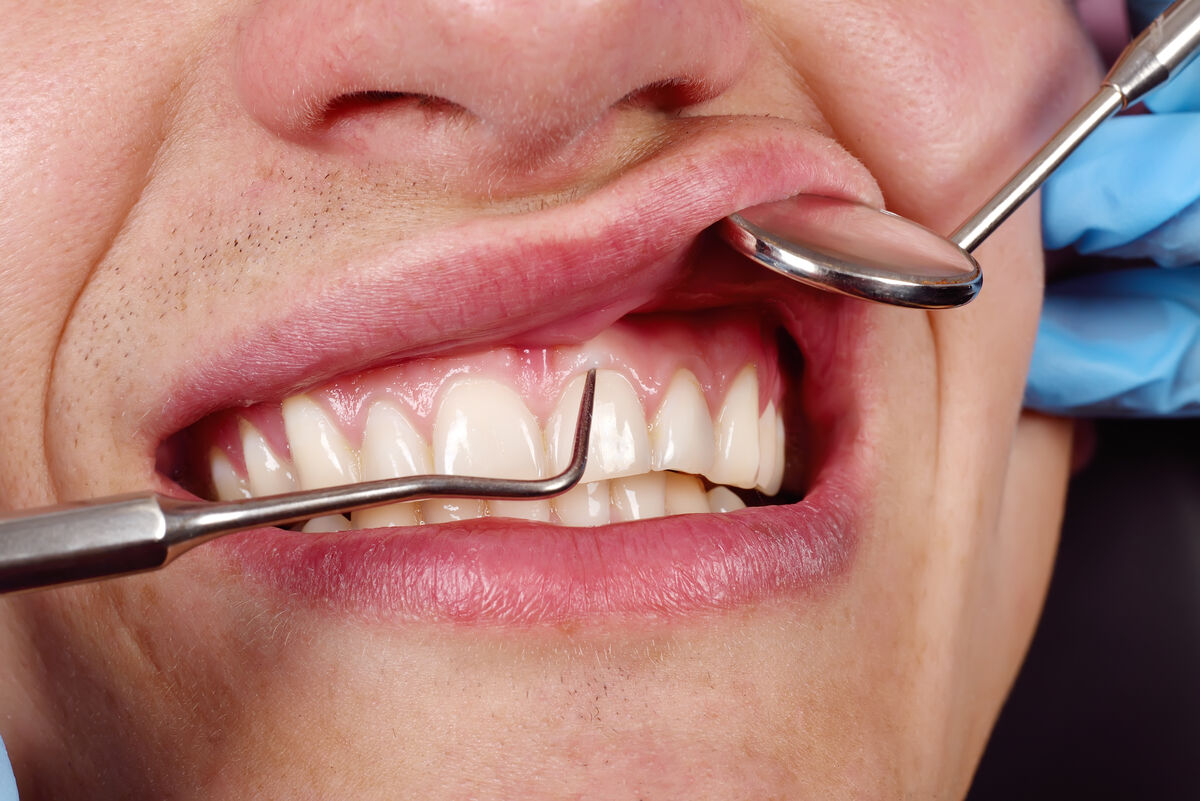 Bleeding Gums: What Are the Warning Signs and How to React?