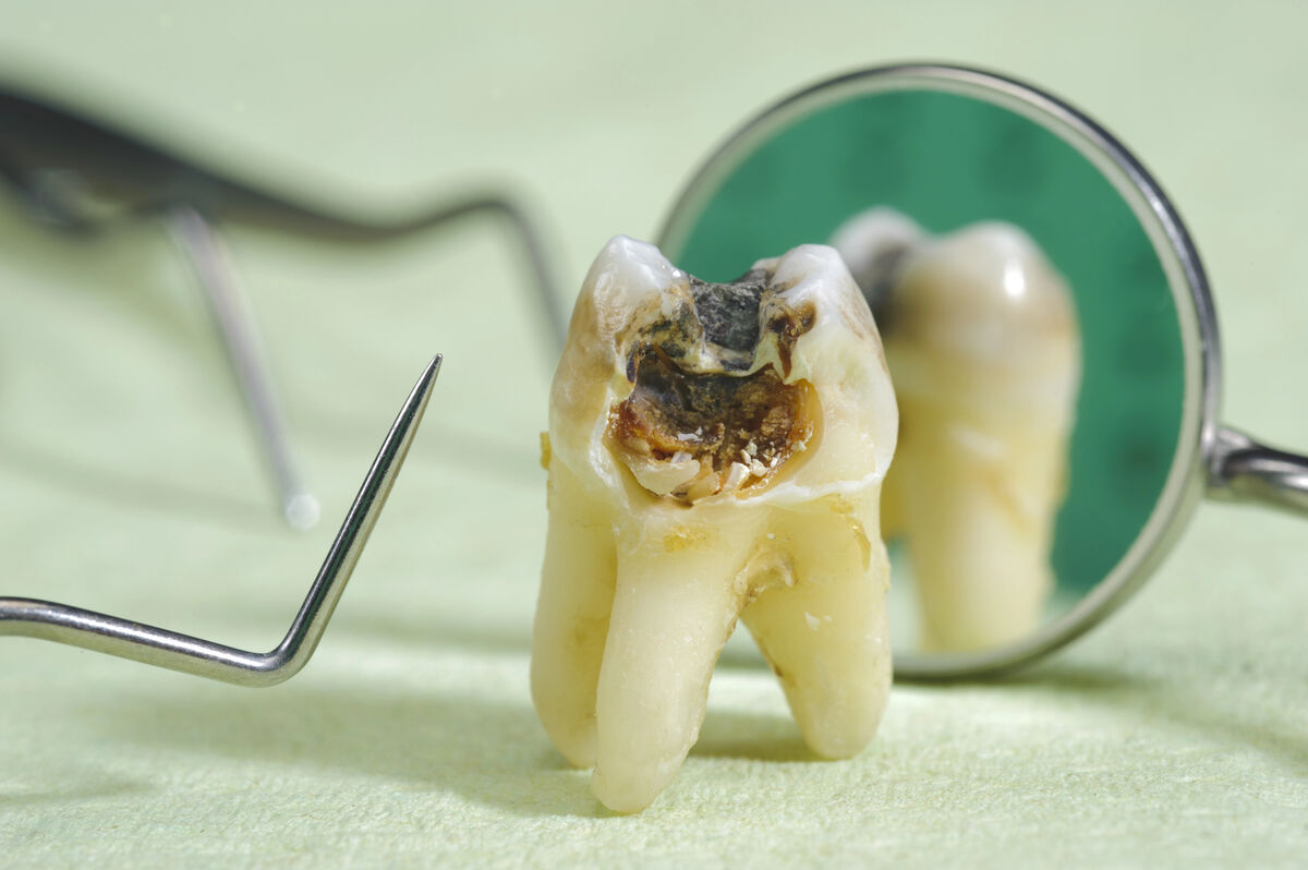 Everything About Dental Cavities: Causes, Symptoms, Treatment, and Prevention