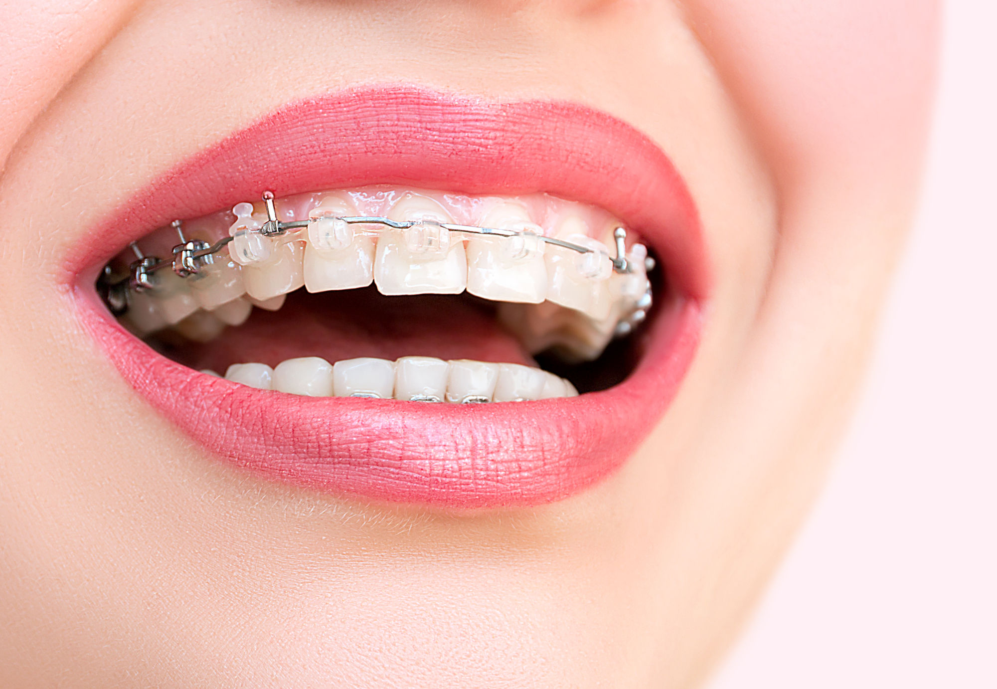 Ceramic Braces: An Aesthetic Alternative for a Discreet Smile