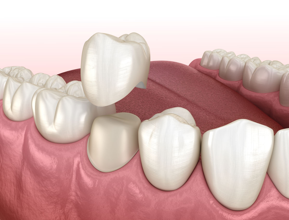 Dental Crowns: Types, Materials, Price, and Reimbursement