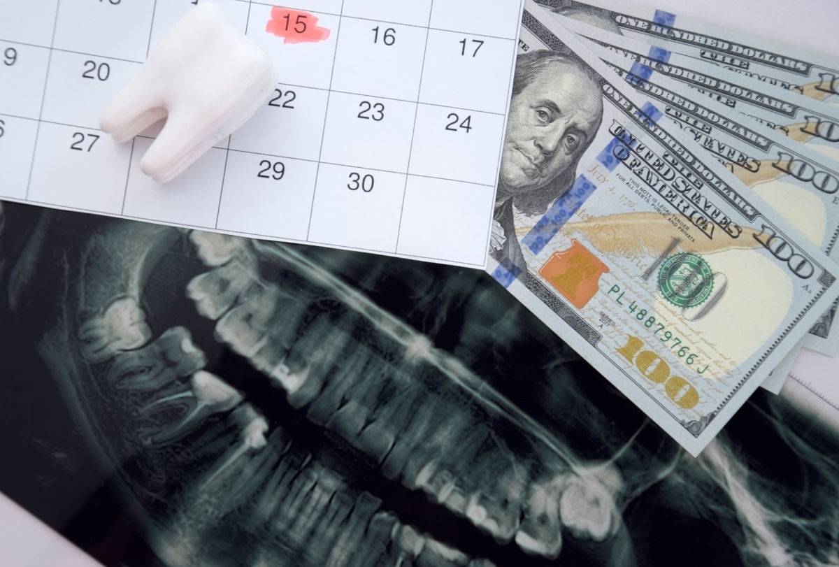 Dental Credit: A Solution to Finance Your Care and Implants