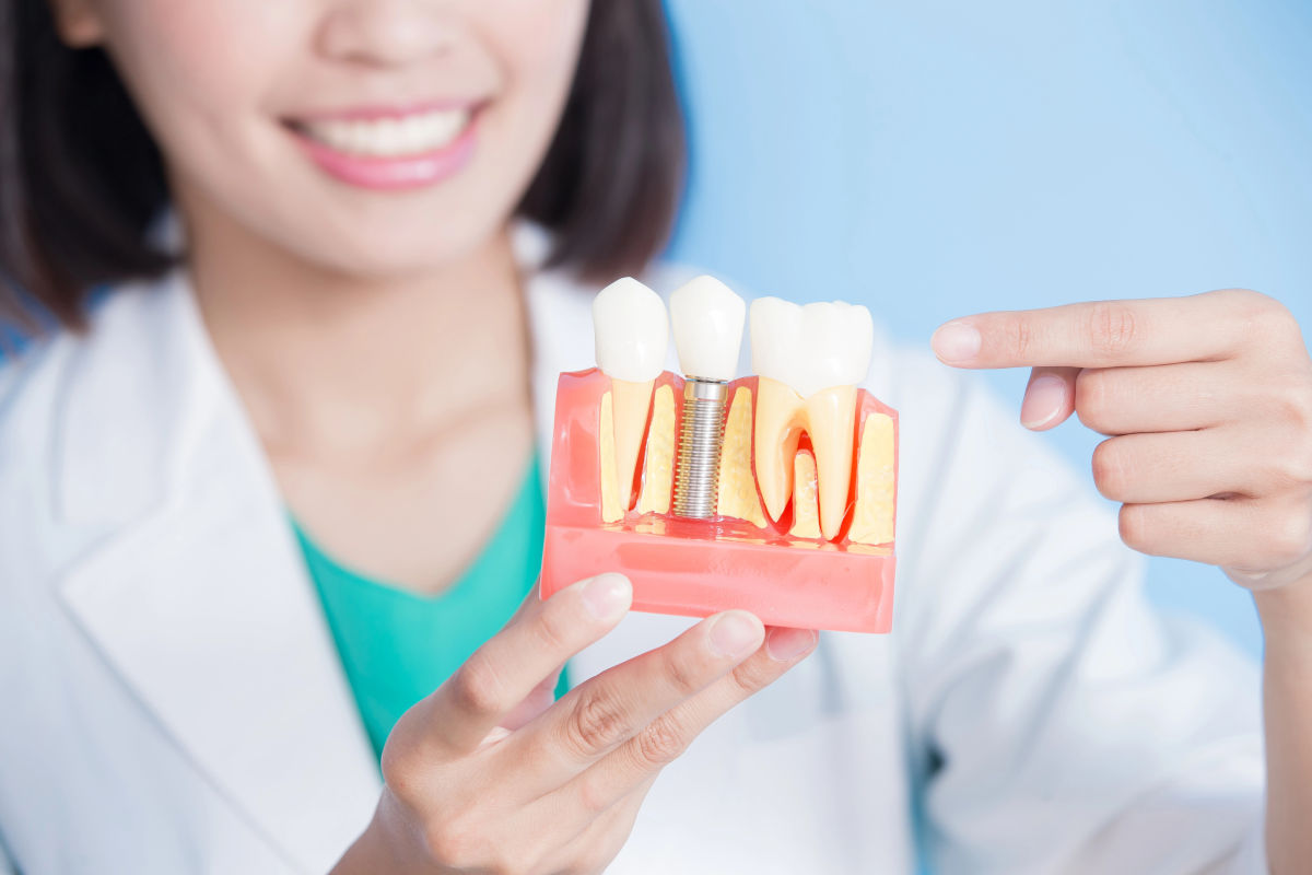 Dental Implants: Everything You Need to Know Before You Start