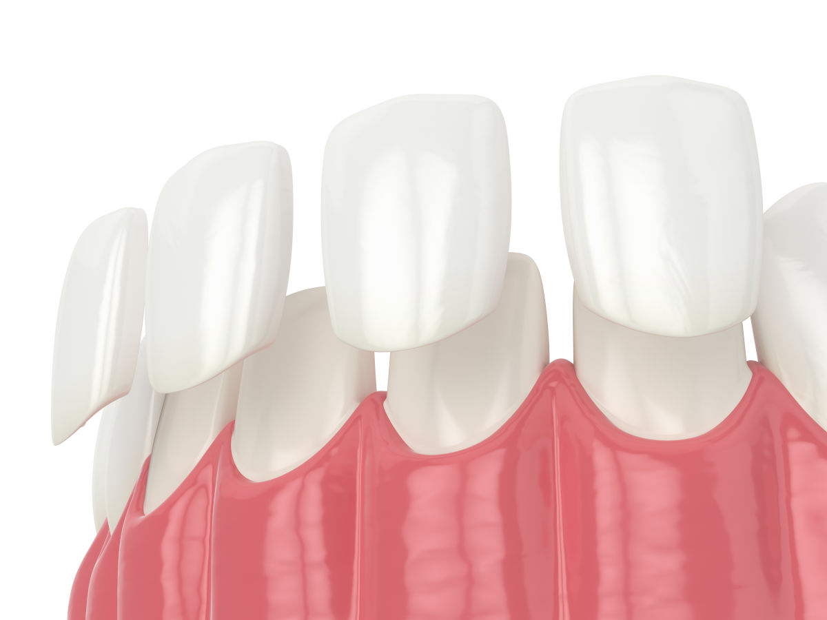 Dental Veneers: Everything to Know About This Aesthetic Solution for a Perfect Smile