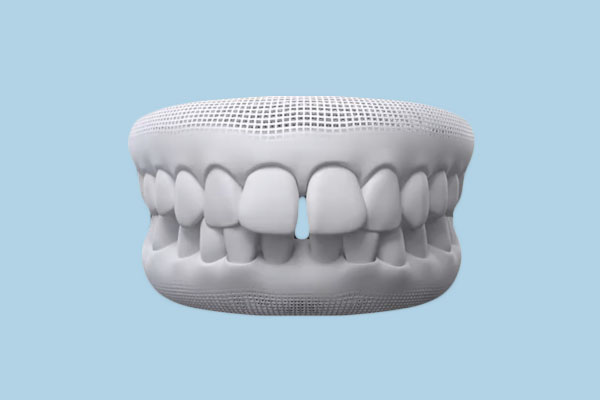 Diastema: Everything You Need to Know About 'Gap Teeth'