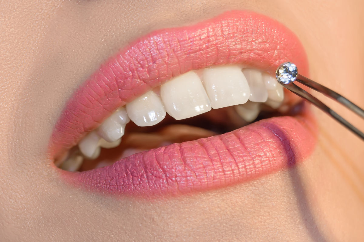 Grillz, Gems, and Tooth Tattoos: The New Trend That Worries Dentists