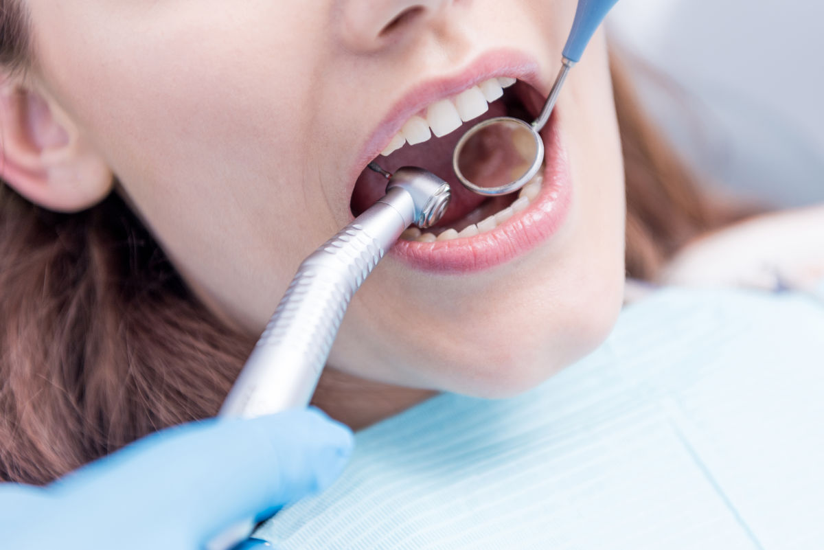 Dental Stripping: Everything You Need to Know Before Filing Your Teeth