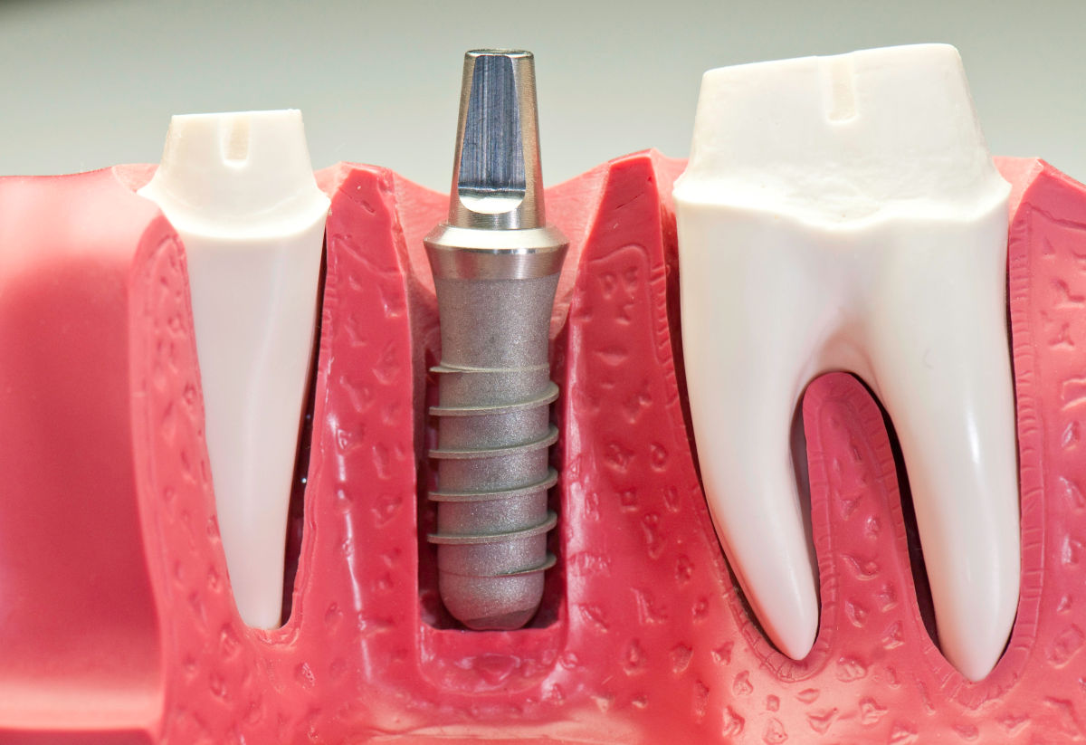 Affordable Dental Implants in 2026: The Ultimate Guide to Saving Money