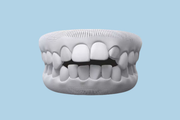 Dental Open Bite: Causes, Consequences, and Solutions at Any Age