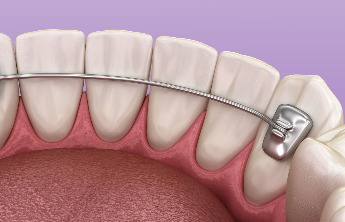 A Complete Guide to Orthodontic Retainers