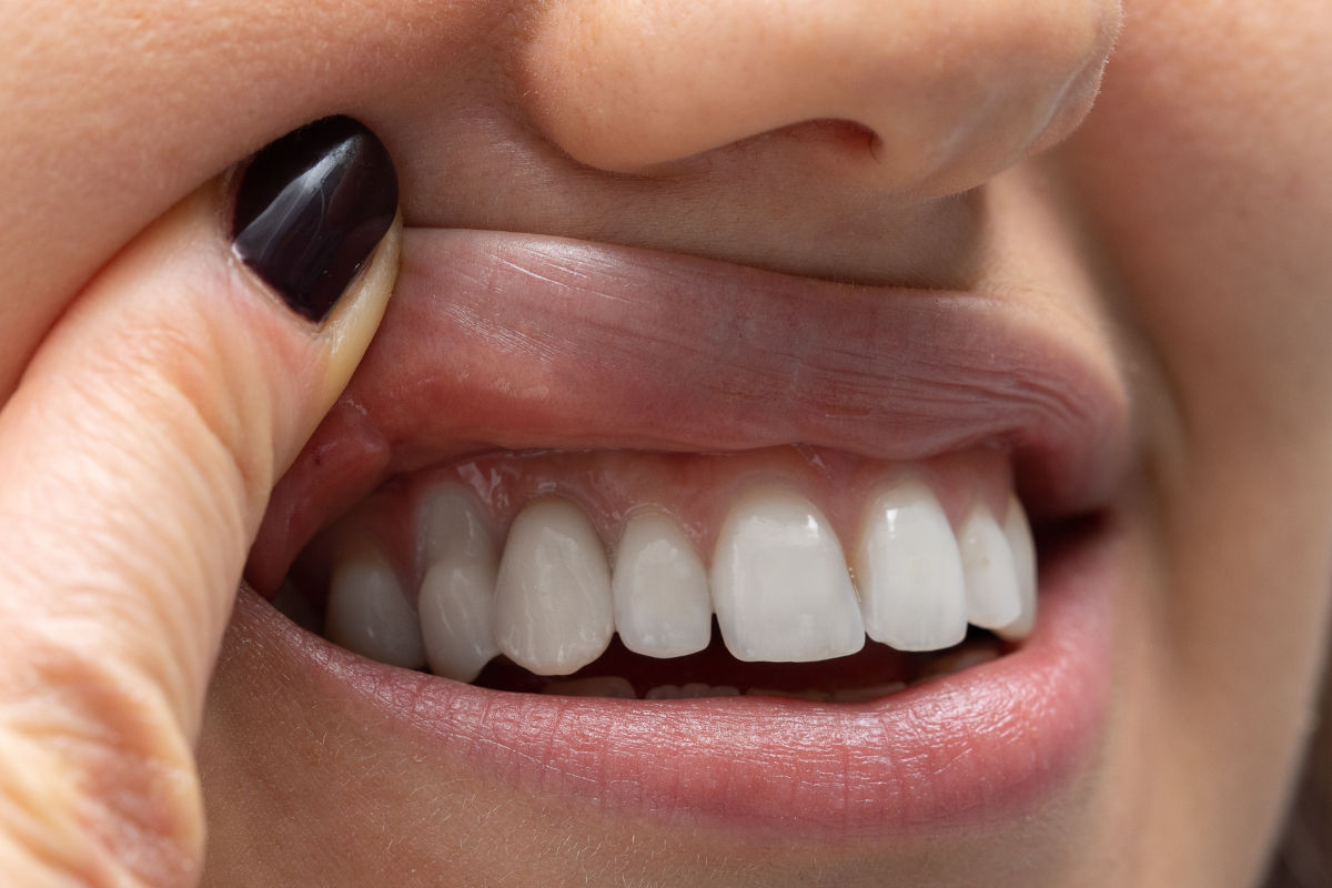 Periodontitis: Causes, Symptoms, and Treatments for This Gum Disease