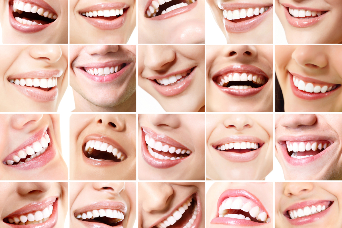 Before-and-after example of a smile enhanced with porcelain veneers