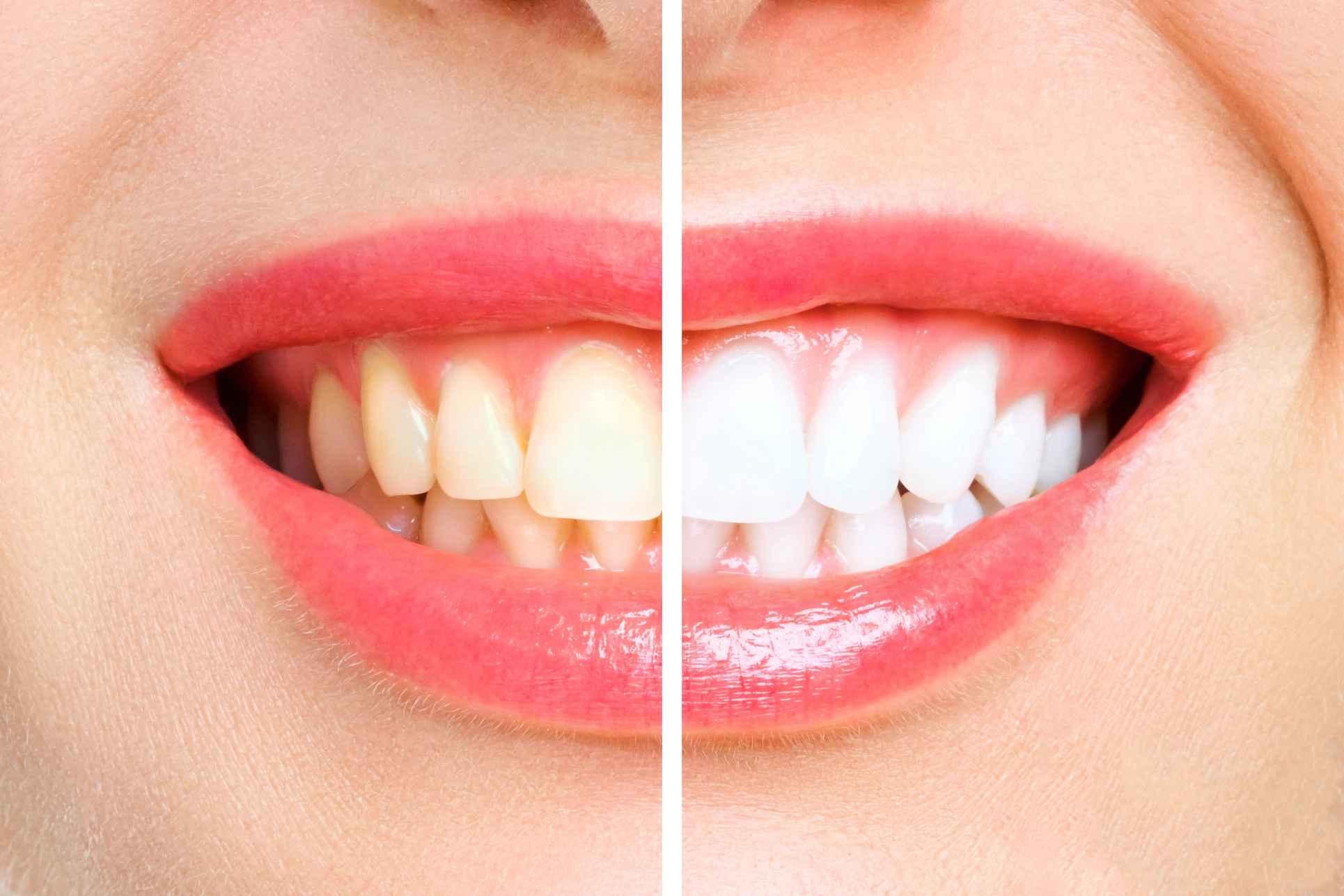 Teeth whitening insurance coverage guide