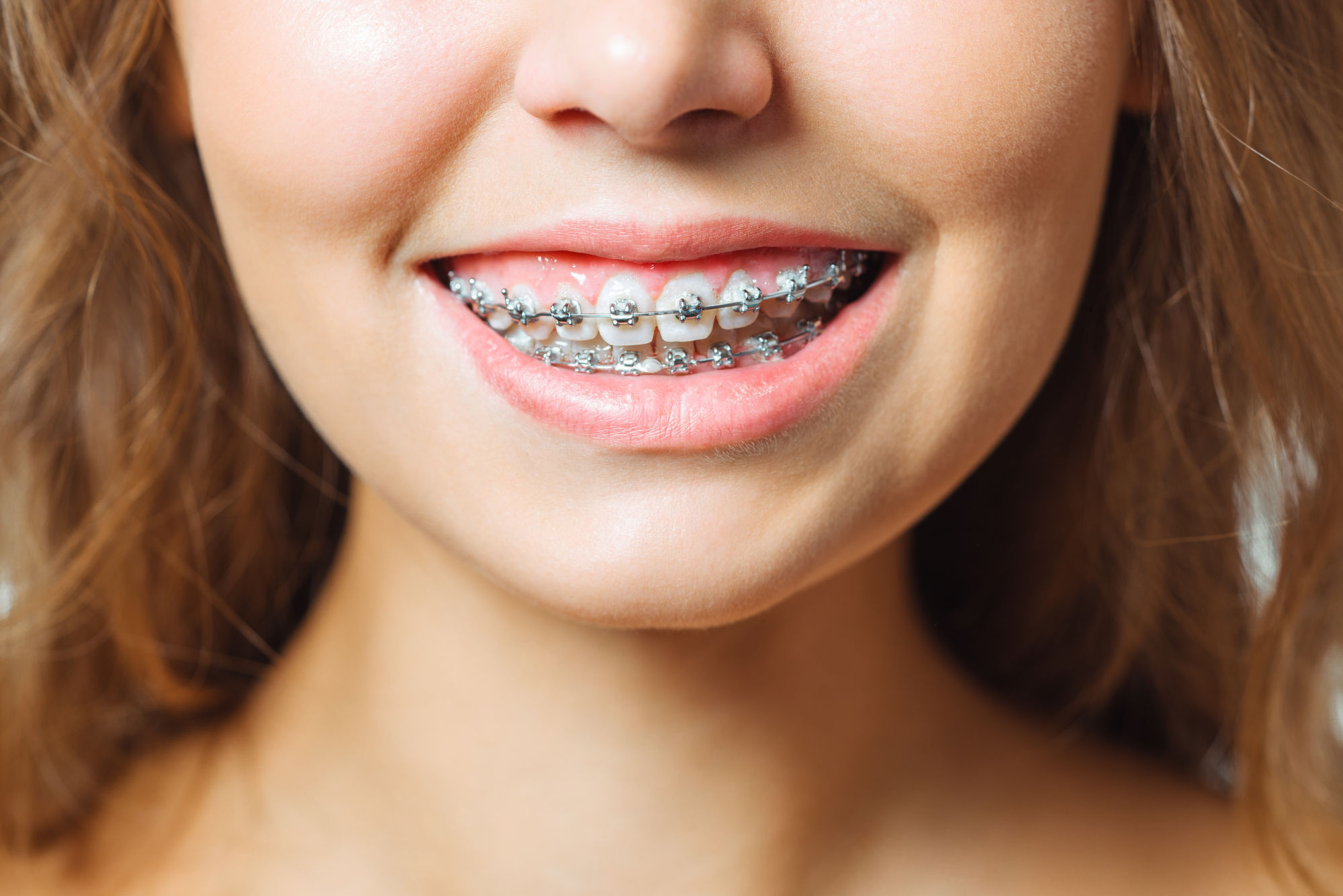 The Different Types of Dental Braces: Features, Advantages, and Disadvantages
