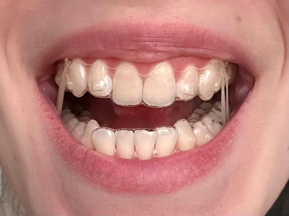 Orthodontic Elastics with Invisalign: Everything You Need to Know