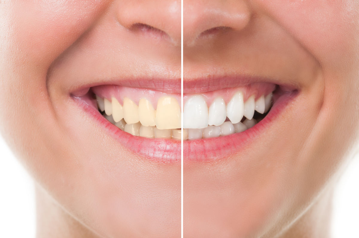 Yellow Teeth: Causes and Solutions to Get a Bright Smile Back